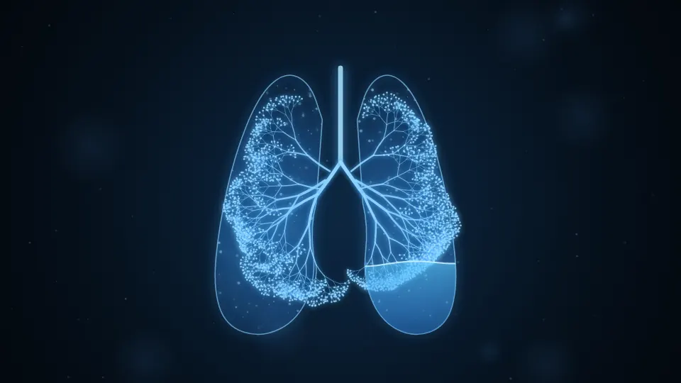 Pleural Effusion illustration