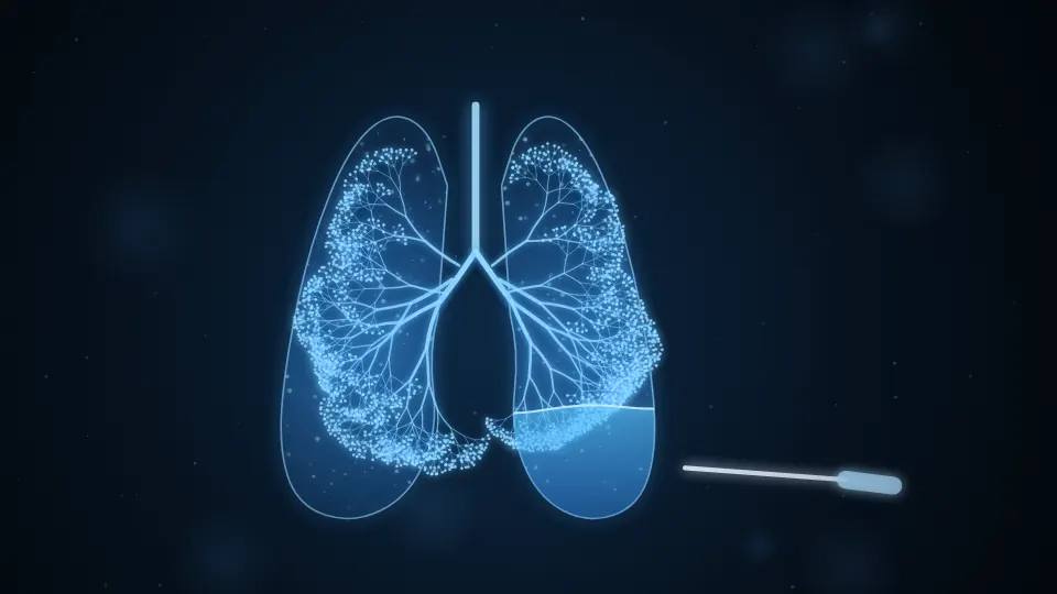 Pleural Fluid Aspiration / Thoracentesis illustration